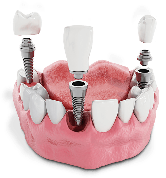 multiple-dental-implant-model
