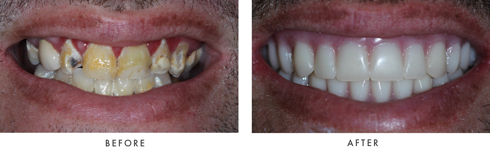 before and after Dental Implant Treatmemnt