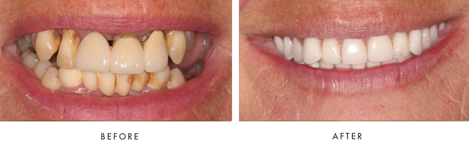 before and after Dental Implant Treatmemnt