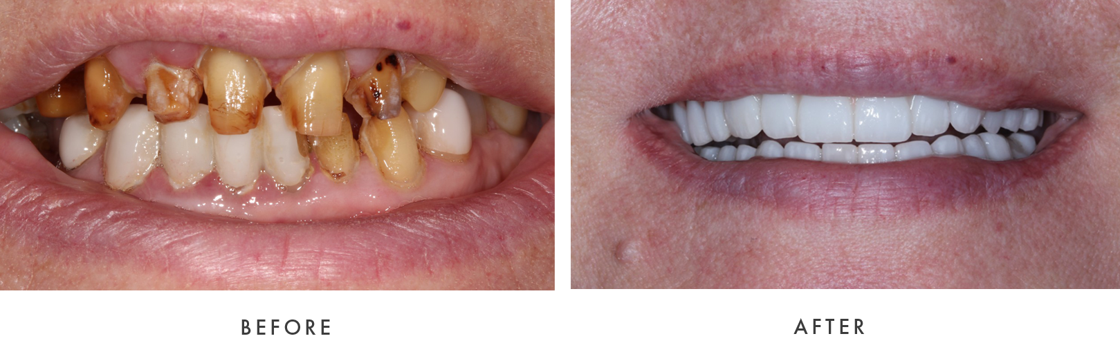 before and after Dental Implant Treatmemnt