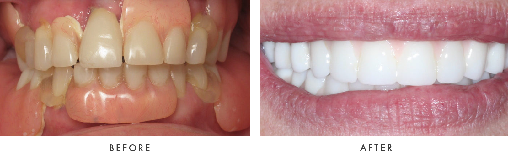 before and after Dental Implant Treatmemnt