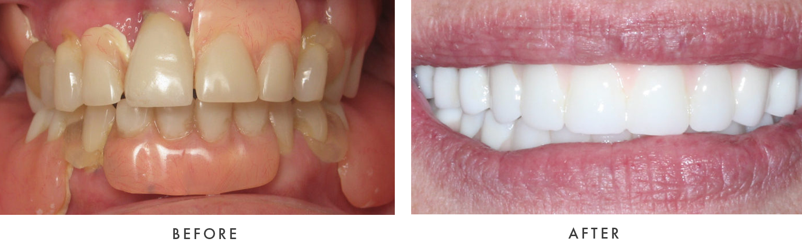 before and after Dental Implant Treatmemnt