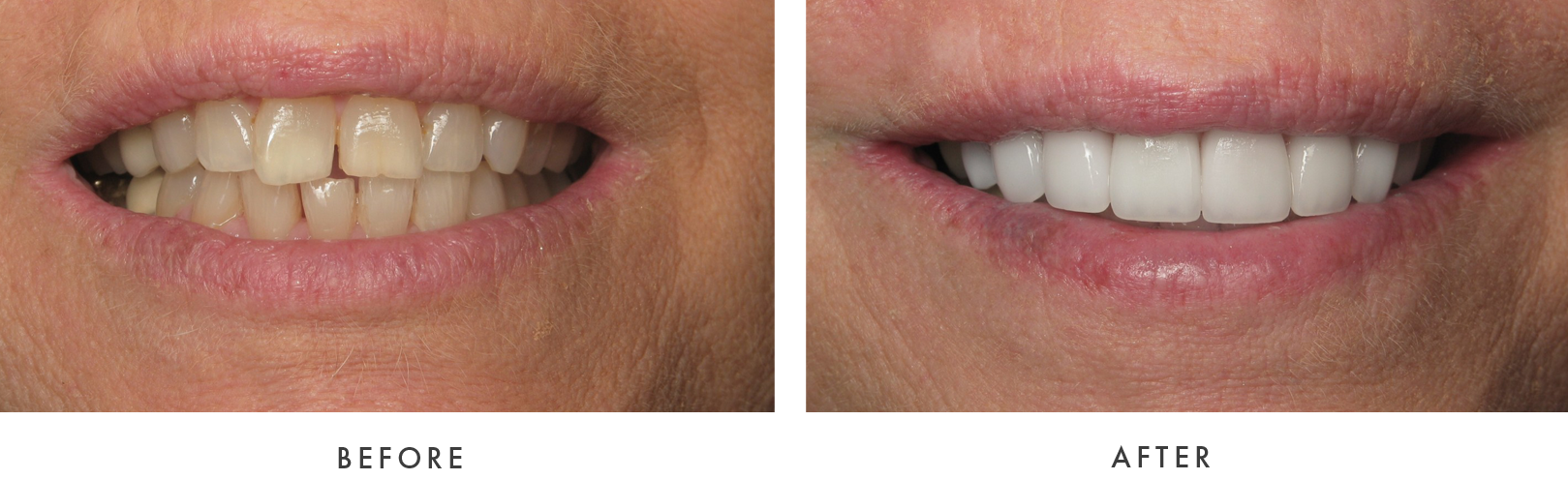 before and after Dental Implant Treatmemnt