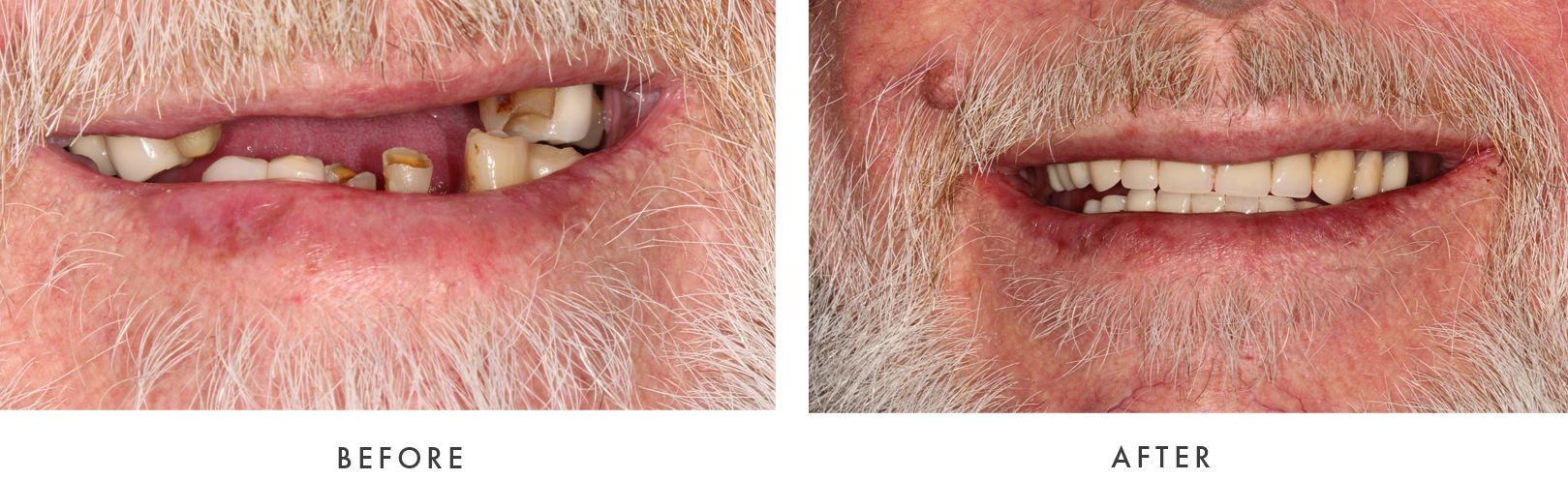 before and after Dental Implant Treatmemnt