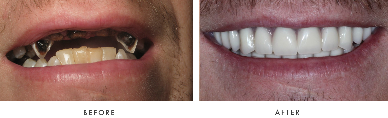 before and after Dental Implant Treatmemnt