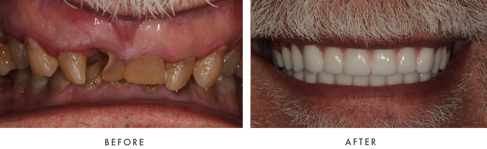 before and after Dental Implant Treatmemnt