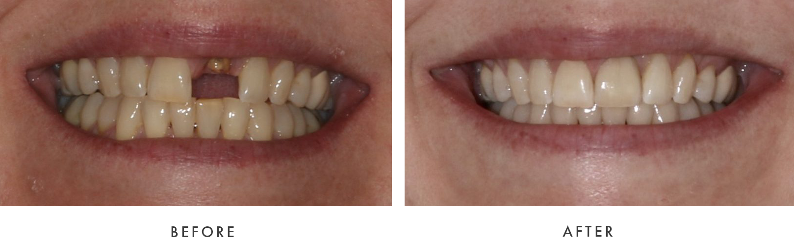 before and after Dental Implant Treatmemnt