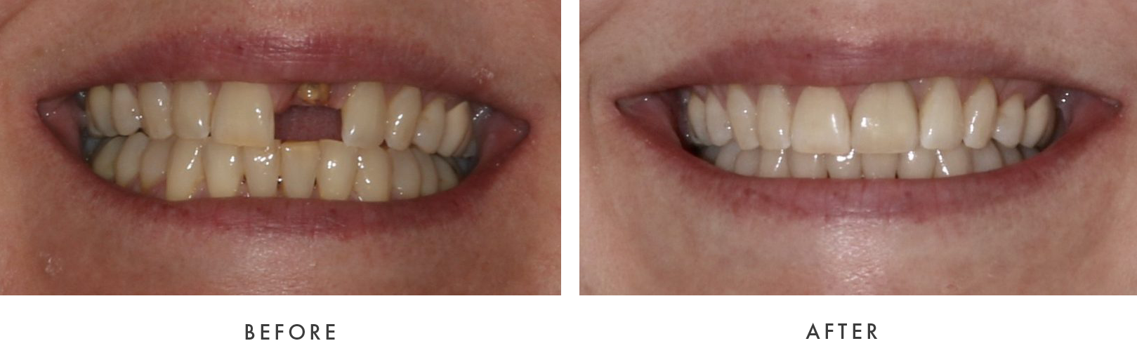 before and after Dental Implant Treatmemnt