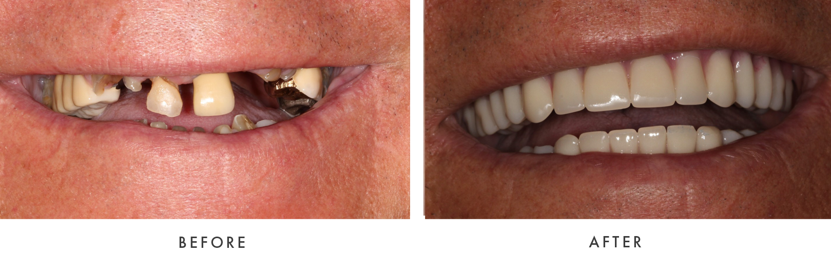 before and after Dental Implant Treatmemnt