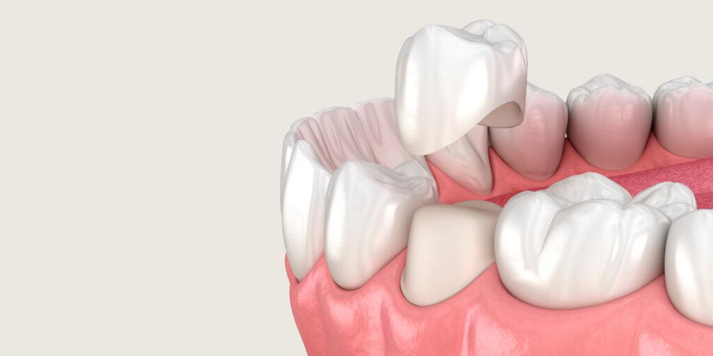 Dental Crown model