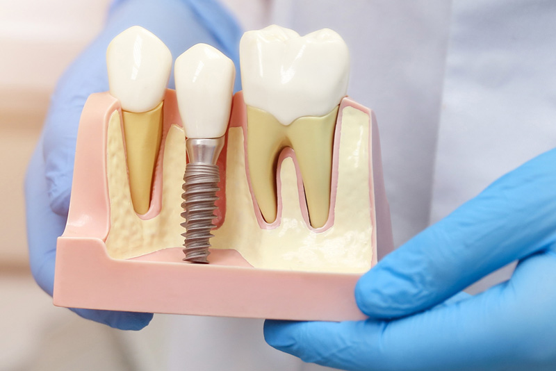 Single Dental Implant Model