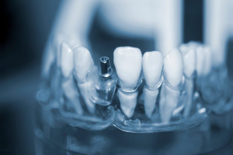 Image showcasing a timeline of dental implant stages, from initial consultation and implant placement to abutment connection and final crown fitting, highlighting key steps and approximate healing times. No text.