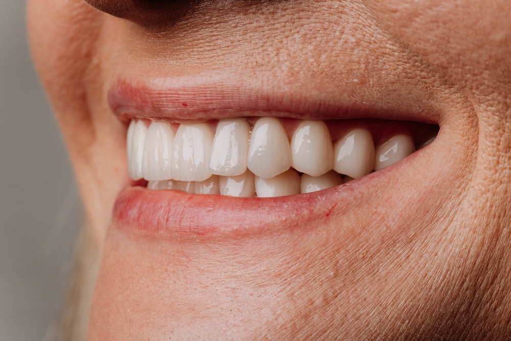A close up of a person smiling, with focus on their new, bright, and natural-looking front implant teeth. No text on the image.